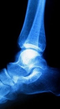 Pittsburgh Podiatrist | Pittsburgh Haglund's Deformity | PA | Sciulli Foot and Ankle Clinics |
