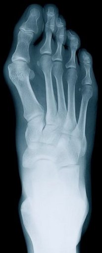 Pittsburgh Podiatrist | Pittsburgh Rheumatoid Arthritis | PA | Sciulli Foot and Ankle Clinics |
